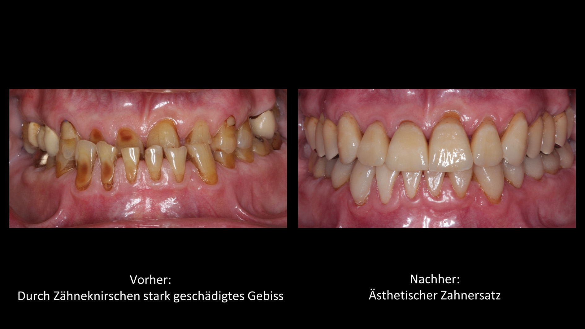 Funktionale und ästhetische Zahnfüllungen - Zahnarzt